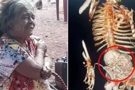 Eine Frau, die eine Eileiterschwangerschaft hatte, starb während einer Operation zur Entfernung des toten Fötus, den sie 56 Jahre lang in sich getragen hatte.